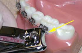 The adhesive or glue can weaken or break, causing the bracket to come loose. Treatment Support