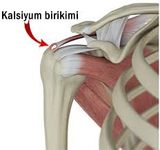 Kalsifik Tendiniti Nedir Prof Dr Levent Altinel Antalya Ortopedi Doktoru Meniskus On Capraz Bag Diz Protezi Kalca Protezi Ortopedi Ve Travmatoloji Ortopedi Uzmani Ortopedi Cerrahisi Kireclenme Omuz Artoskopisi Kirik Tedavisi