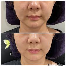 診所有了陳尹陽醫師乳房外科/醫學美容加入之後，許多產後來諮詢及施作乳暈/乳頭整形手術的媽媽們。許醫師兩胎從懷孕到生產，都脹奶到G/H  cup，剖腹產後三天下床到浴室擦澡時，脫下衣服看見自己脹大的胸部，瞬間哭了出來。身形的改變帶來的衝擊，只有自己能深刻體會。 透過 ...