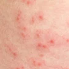 In the united states, it's estimated that doctors diagnose over 100,000 new skin cancer cases each year. Skin Rash Causes 68 Pictures Of Symptoms And Treatments