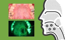 Image result for dental cancer
