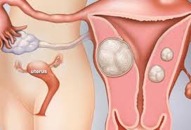 If you have symptoms of a uterine condition, it can be difficult to know if something serious is going on. Uterine Fibroid Symptoms Treatment Causes Surgery