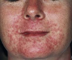 Unfortunately, experts say there's no cure to get rid of perioral dermatitis overnight. That Rash Around Your Mouth Might Be Perioral Dermatitis Zi Zai Dermatology