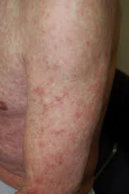 Allergy To Sulfonamides Journal Of Allergy And Clinical Immunology