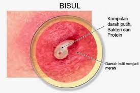 Sementara untuk bisul yang sangat besar atau banyak (karbunkel), disarankan. Rawat Bisul Dengan Cepat Shidarahmat