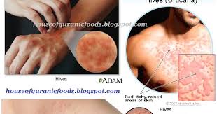 Ambil kulit walnut secukupnya lalu giling atau hancurkan sampai menjadi bubuk. House Of Aafiyat Lifestyle O L I V E H O U S E Petua Rawatan Gegata Kelopak Garam Hives Urticaria