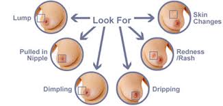 The purpose of breast screening is to find breast cancer at its earliest, most treatable stages. Breast Cancer Signs Of Breast Cancer Kimaja Farwani