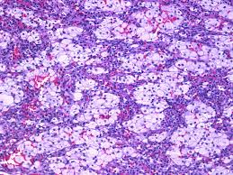 Type a, type b, type c1, and type c2. Webpathology Com A Collection Of Surgical Pathology Images