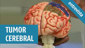 tumor cerebral causas sintomas e tratamentos entrevista tv aparecida youtube