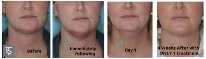 How long does kybella last: How To Get Rid Of A Double Chin
