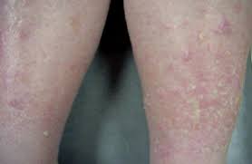 This lack of hydratation it is usually due to aging (senile xerosis) or pathologies such as diabetes. Xerosis Dry Skin Dermatology Advisor