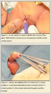 Use medical gauze to prevent the bandage from sticking to the incision. Newborn Circumcision The Gomco Method Consultant360