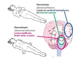 Medicina Critica Pediatrica On Twitter En La Valoracion Motora De La Escala De Coma De Glasgow La Postura De Decorticacion Da 3 Puntos Y La De Descerebracion Da 2 Puntos Hemos Detectado On emotional expression after decortication with some remarks on certain theoretical views: