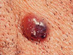 A normal mole is solid tan, brown, dark brown, or flesh colored. Is It Skin Cancer 38 Photos That Could Save Your Life Pictures Cbs News