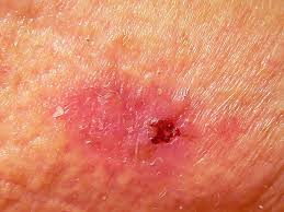 Rough or scaly red patches, which might crust or bleed Causes Of Scaly Skin And How To Get Rid Of It Health Com