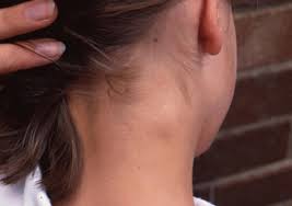 Swelling or sore that does not recover; Lump On Neck Causes And Pictures