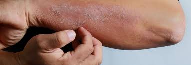 They can be red, itchy, scaly, or dry; Contact Dermatitis Symptoms And Treatment Vanguard Dermatology