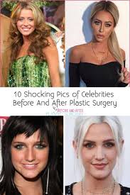 10 Shocking Pics Of Celebrities Before And After Plastic Surgery Celebrities Before And After Celebrities Plastic Surgery