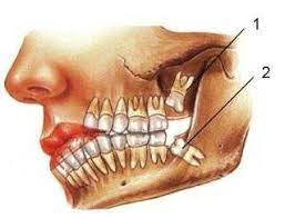 Kista Adalah Sebuah Rongga Abnormal Yang Dibatasi Oleh Epithelium Suatu Keadaan Yang Abnormal Dan Me Oral Surgeon Tooth Extraction Aftercare Cosmetic Dentistry