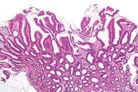 His immunological work up showed normal level of immunoglobulins and his white blood cells subpopulations were normal. Reactive Gastropathy Wikipedia