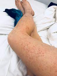 Medical names for itch starting in the skin can be pruritus, dermatological itch, or pruritoceptive itch. Living With Eczema Chronic Hives The Balanced Blonde
