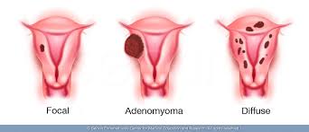 Endometriosis and adenomyosis both affect the female pelvis but are separate gynaecological conditions with some differing symptoms. Adenomyosis Symptoms Causes And Treatments Sec Dr Seckin