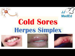 Image result for oral herpes symptoms roof of the mouth