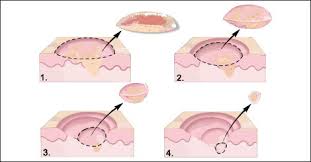 Of course, your specialist is the main person whose advice you should follow but it doesn't do anyone harm. Skin Cancer Diagnosis Test Natural Treatment Prognosis