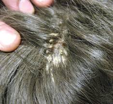 Pityriasis amiantacea was first described by alibert in 1832. What Are These Thick Clumps Of Scalp Scales Binding A Boy S Hair Consultant360