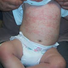 Jun 02, 2016 · an amoxicillin rash by itself isn't dangerous if your child doesn't have an allergy to the medication. Epstein Barr Virus And Amoxicillin Download Scientific Diagram