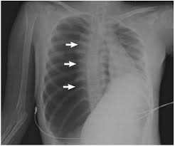 Image result for Open Pneumothorax