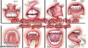 هام جدا 8 أعراض لاكتشاف سرطان الفم في وقت مبكر احمي نفسك الوطن