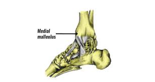 Malleolar fractures include injuries of bones (malleoli) and or ligaments. Medial Malleolus Stress Fracture Symptoms Cauess Treatment
