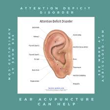 Do You Or A Loved One Struggle With Attention Deficit Disorder Earacupuncture Can Help Auriculo3d Is In 2020 Acupuncture Ear Acupressure Points Acupuncture Points