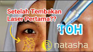 Check spelling or type a new query. Before After Laser Toh Tanda Lahir Nevus Of Ota Natasha Skincare Sidoarjo Youtube