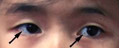Image result for melanosis sclera
