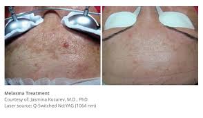 Well here is a full demo so you can see exactly what it is like so you know. 50 Best Laser Hair Removal Clinic In Melbourne 2021