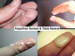 Mempercepatkan penyembuhan luka akibat pembedahan. Cara Mengobati Keputihan Abnormal Dengan Obat Tradisional Obat Keputihan