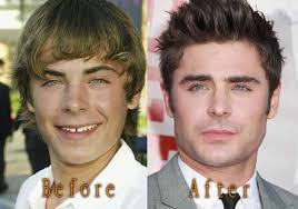 In both cases, use the techniques of natural rejuvenation. Zac Efron Nose Job Before And After Top Celebrity Surgery
