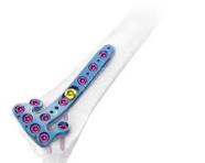 2.4mm AV-WISELOCK Distal Radius & Volar Rim System