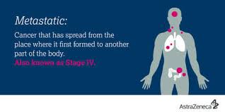 Lung cancer often goes unreported in the early stages making treatment more difficult as it tends to spread to other parts of the body as the disease progresses. Making Some Sense Of Lung Cancer
