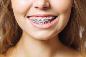 Howard fine, director of orthodontics at touro college of dental medicine in hawthorne, new york. How Much Are Braces Prices For All Brace Types In The Uk