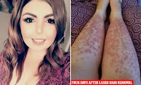 Researching laser hair removal packages and found a 6 session full body and face package for $5,500. Woman S Body Reacted With Huge Hot Hives After Laser Hair Removal Procedure Daily Mail Online