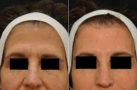 We did not find results for: How Often Should You Get Botox Injections Boston Botox Krauss Dermatology
