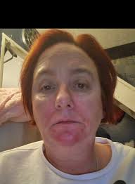 How does sleep apnea affect cochlear implant?