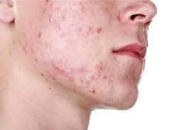Crema Para El Acne Cual Es La Mejor 2022