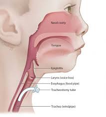 Image result for Tracheostomy
