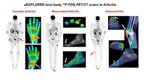 The next part of our human body series is learning about the bones, joints and muscles. Total Body Pet Ct Captures Full Picture Of Systemic Inflammatory Arthritis Eurekalert Science News