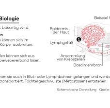 Chemotherapie Das Sind Alternativen In Der Krebstherapie Welt