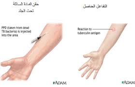 Tb is spread from person to person through the air. Ø§Ù„Ø£Ù…Ø±Ø§Ø¶ Ø§Ù„Ù…Ø¹Ø¯ÙŠØ© Ø¯Ø§Ø¡ Ø§Ù„Ø¯Ø±Ù† Ø§Ù„Ø³ Ù„
